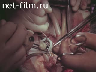 Film Heart valve "Emiks.". (1987)