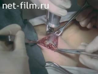 Film Lasers in Surgery. Section I.. (1985)
