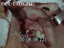 Фильм Амбулаторные стоматологические операции. (1987)