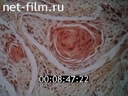 Film Diagnosis and treatment of lung cancer.. (1986)