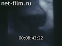 Film Diagnosis and treatment of esophageal cancer.. (1988)